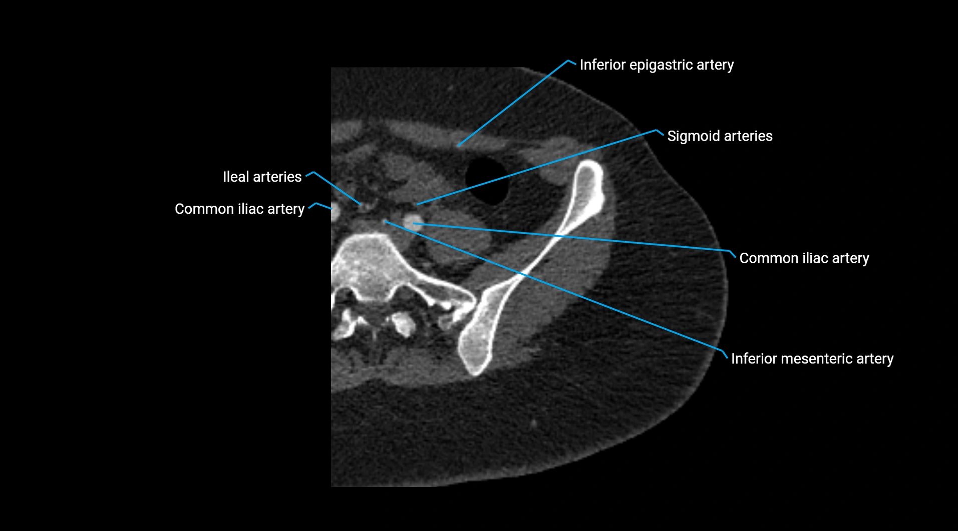 CTA lower limb cross sectional anatomy labelled image _14.webp